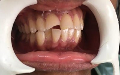 Dental Implants