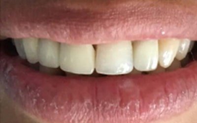 root canal treatment