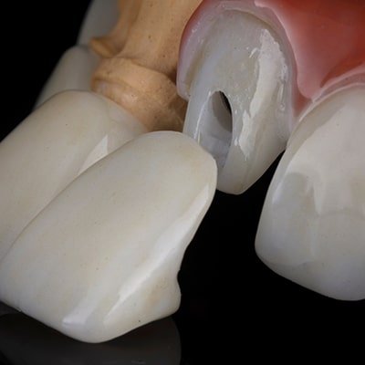 Porcelain Veneers
