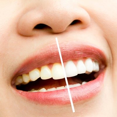 Teeth Whitening