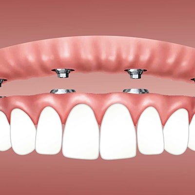 Dental Implants