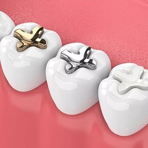 Cavity Fillings