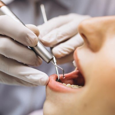 Gum Depigmentation