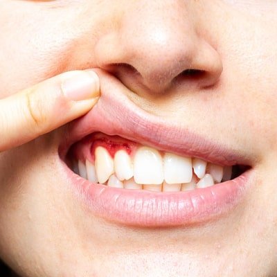 Periodontal Surgery