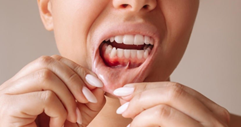 Gum Treatment