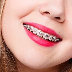 Ceramic Braces
